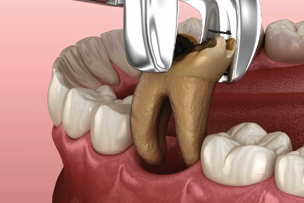 Extractions
                